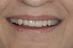 After Denture Smile