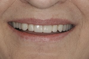 After Denture Smile