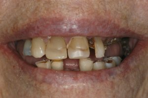 Before denture implant smile