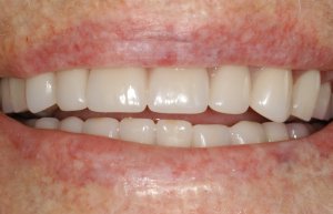 After denture implants and more