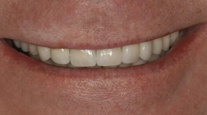 After full mouth reconstruction of teeth