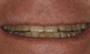 Before a full mouth reconstruction with doug erickson