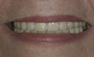 After full mouth reconstruction of smile