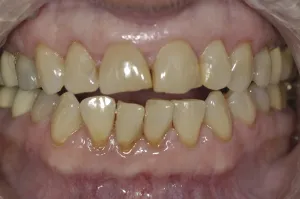 Before a full mouth reconstruction