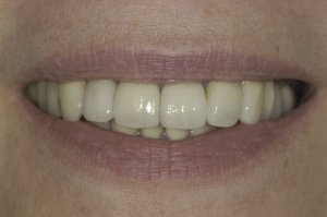 After full mouth reconstruction of teeth