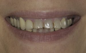 Before a full mouth reconstruction smile