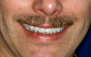 After full mouth reconstruction of smile