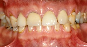Before a full mouth reconstruction of teeth