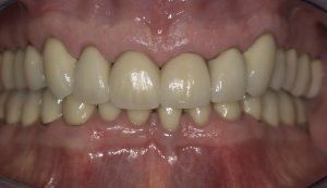 After full mouth reconstruction of smile