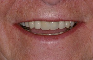 After full mouth reconstruction of smile