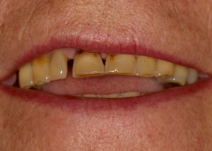 Before a mouth reconstruction of all teeth