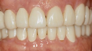 After full mouth reconstruction of teeth