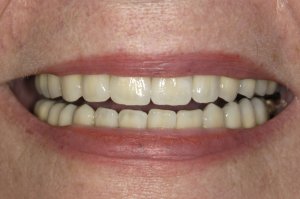 After Full mouth reconstructions
