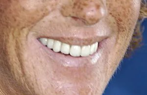 After Implant Crown Reconstruction