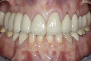 After implant Crown Reconstructions