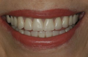 After Implant Reconstruction at Dental Implant and Reconstructive Center