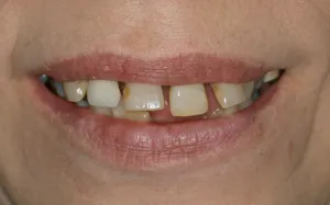 Before Implant Reconstruction at Dental Implant And Reconstructive Center