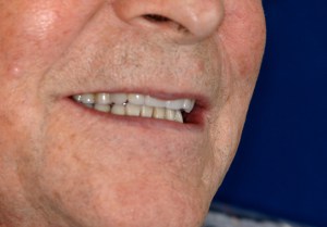 After Implant snap denture smile