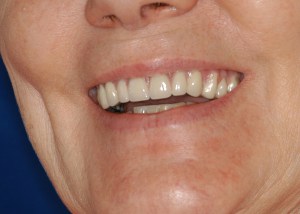 Implant snap denture testimonial