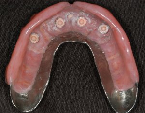 Inside of a snap denture