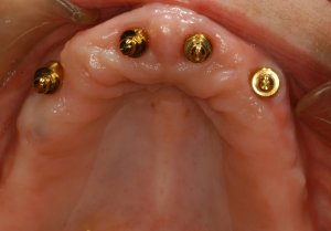 Implant snap denture for the upper jaw