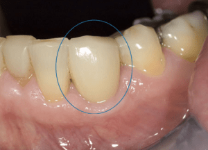 Single implant crown