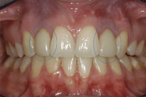 Single tooth Implant for crowns