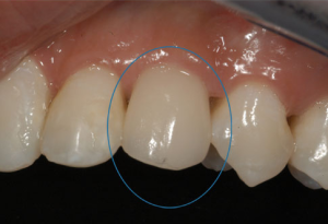 single tooth implant