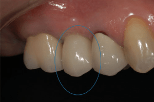 implant crowns by dr doug erickson