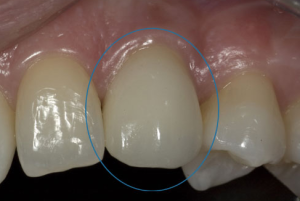 Dental implants for one teeth