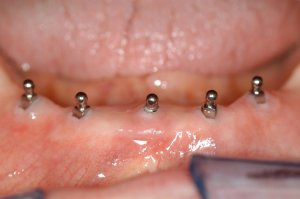 implant snap denture after an implant reconstruction