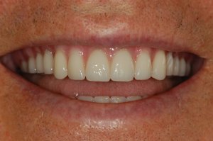 after an IMZ implant snap with Dr. Doug Erickson