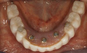 dental Implant Reconstruction after Minor Arch