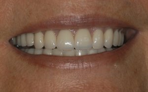 after dental Implant Reconstruction