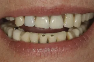 Before Dental Implant Reconstruction