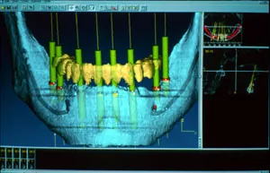 Dental Implant Surgical Guide