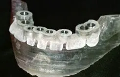 Dental Implant Surgical Guide of dentures