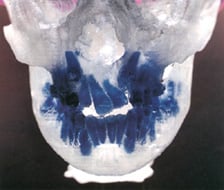 Stereolithography at Dental Implant and Reconstructive Center