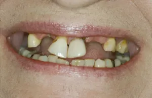 Before denture implants